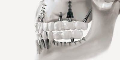 השתלת שיניים בזאלית (אילוסטרציה צילום: המרכז להשתלה בזאלית)