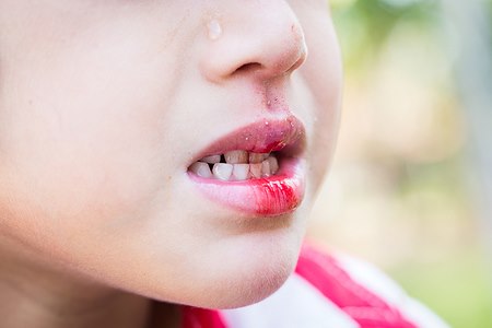 לאן מומלץ לפנות במקרה של חבלה בשיניים? (אילוסטרציה shutterstock)