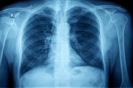צילומי החזה הסטנדרטיים משמשים למטרות מיקוד האבחון. צילום: thinkstock