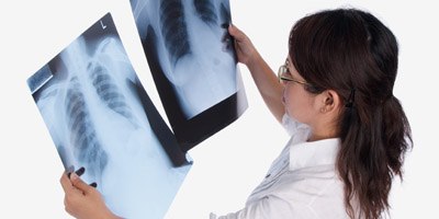 סרטן ריאה (אילוסטרציה)